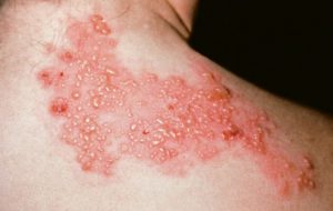 Giornate di sensibilizzazione e vaccinazione contro il Fuoco di Sant’Antonio (Herpes Zoster)