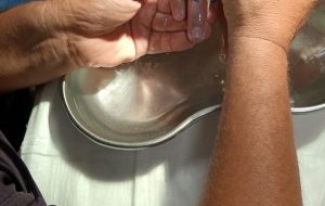 Dito gonfio per una puntura: vigili del fuoco rimuovono l’anello al pronto soccorso