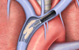 Perrino di Brindisi, primo intervento di estrazione transvenosa di elettrocateteri cardiaci