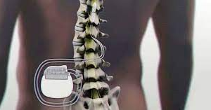 Dolore cronico nella polineuropatia diabetica (Pnd): al Perrino la prima stimolazione spinale in un ospedale pugliese