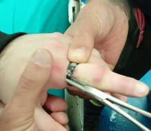 Brindisi, dito gonfio e anello incastrato: intervengono i Vigili del Fuoco al Perrino
