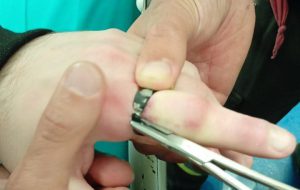 Brindisi, dito gonfio e anello incastrato: intervengono i Vigili del Fuoco al Perrino